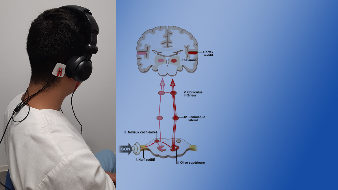 Potentiels évoqués auditifs du tronc cérébral (PEA)
